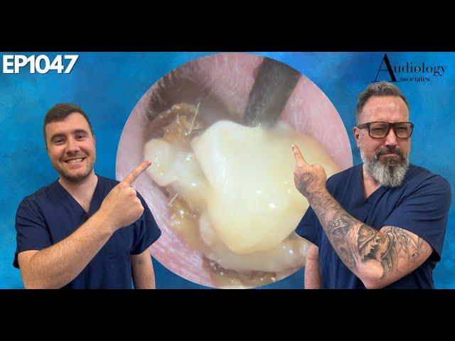 WET MASTOIDECTOMY EAR WAX REMOVAL - EP1047