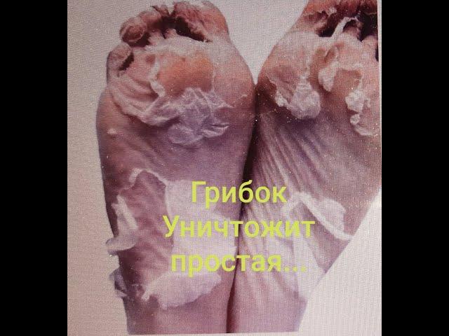 ГРИБОК НОГТЕЙ и ЛЕЧЕНИЕ в ДОМАШНИХ УСЛОВИЯХ. Мощное Средство от Возбудителей.