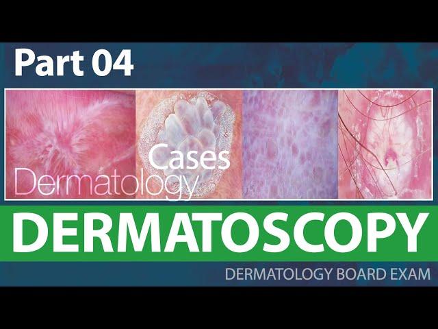 Dermatoscopy  - Dermatology cases