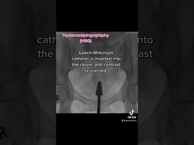 Hysterosalpingography (HSG) #fluoroscopy #radiology #radiologist #womenshealth