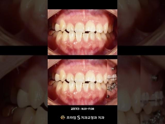 30대 치아교정, 1년 7개월 변화 과정 #치아교정 #교정전후 #교정과정 #교정전문의 #교정전문치과 #쇼츠