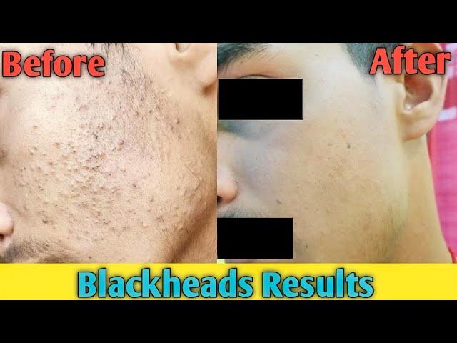 Blackheads Results Before and After | Sahil Nagpal Skin