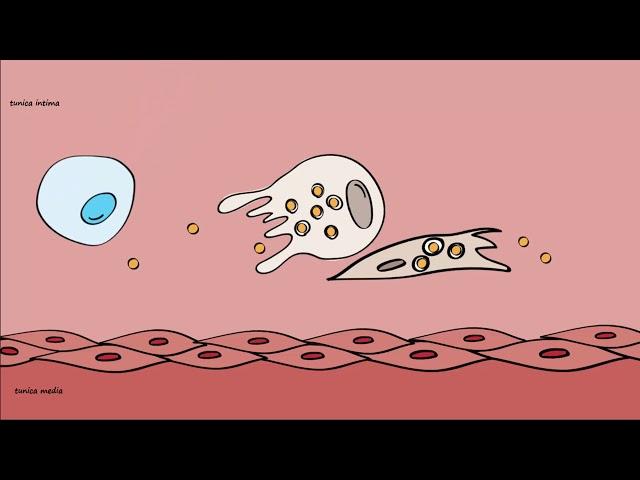 Pathogenesis of Atherosclerosis