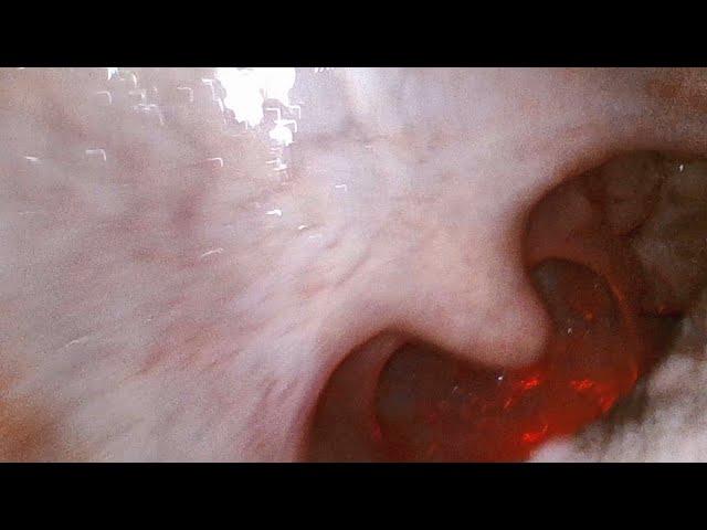 Looking Into a Mouth and Throat with a Tiny Camera