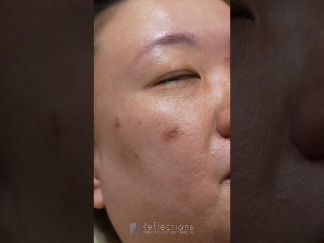 Hyperpigmentation from Acne Scars on Asian Skin