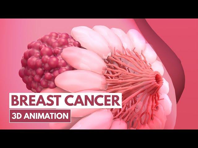 5 Signs of Breast cancer | 3D Animation