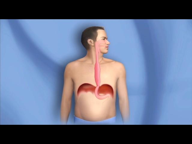 Surgery for Esophagus Cancer, Esophagectomy - Mayo Clinic