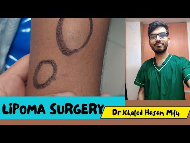 Lipoma Surgery