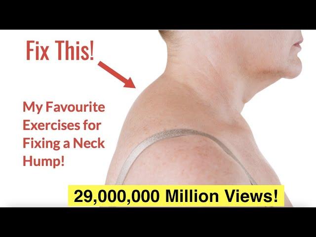 How to Fix a Neck Hump at Home (FAST) | With FREE Exercise Sheet!