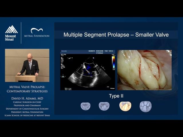 Mitral Valve Prolapse: Contemporary Strategies