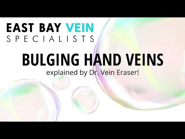 Bulging Veins in Hands? Here's How to Diagnose & Treat Hand Veins