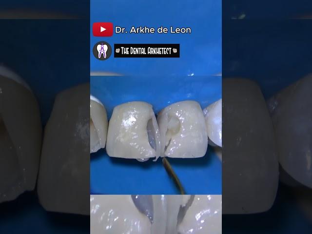 Amazing Restoration of the Patient's Confidence! #dental #oralhealth #dentalcare