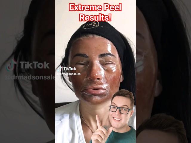 THIS IS CRAZY - Extreme Phenol Peel For Acne Scarring