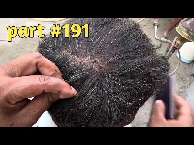 #licepicking  wife removed husband lices || lices removed best video || video part 191 