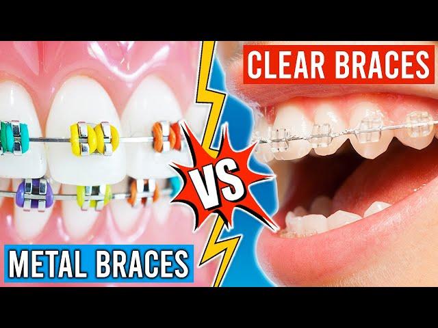 Metal Braces VS. Clear Braces!