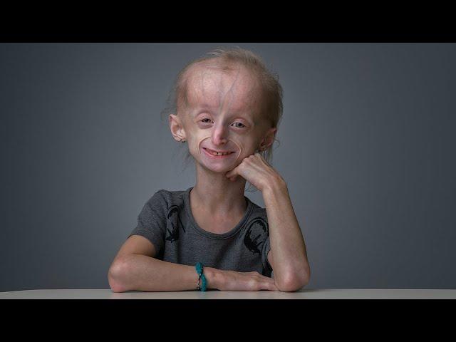 Miracle Story: Carly (Progeria)