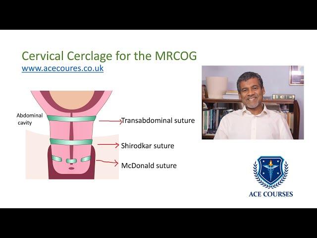 Cervical cerclage for the MRCOG: RCOG Guideline. Preterm Birth. McDonald or Shirodkar suture.