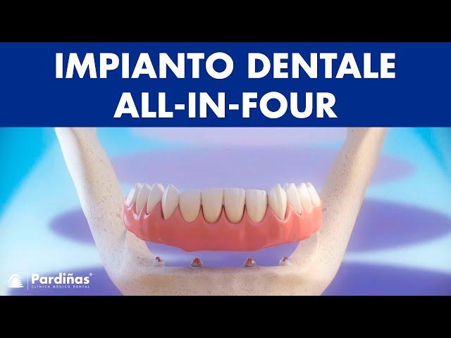 Impianto dentale All-in-four ©