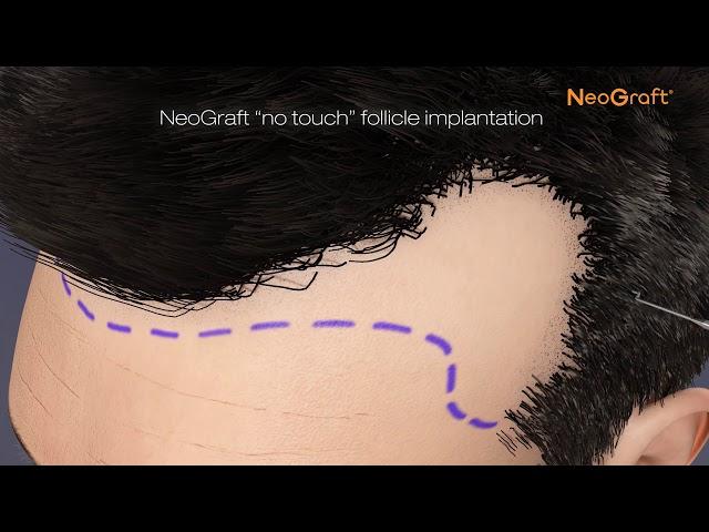 NeoGraft Animation Video