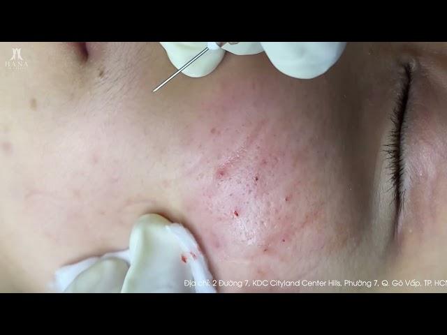 Big Cystic Acne Blackheads Extraction Blackheads & Milia, Whiteheads Removal Pimple Popping