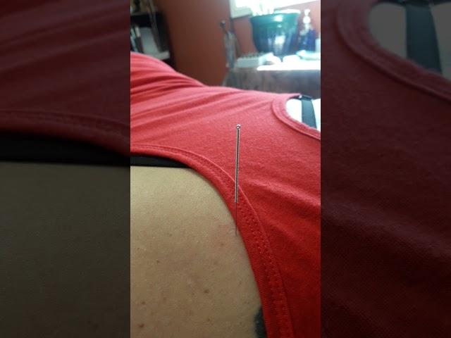 Acupuncture needles turning all by themselves!