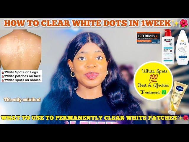 HOW TO GET RID OF WHITE DOTS ON SKIN  Effective Treatment for White Patches on Skin & Best Products