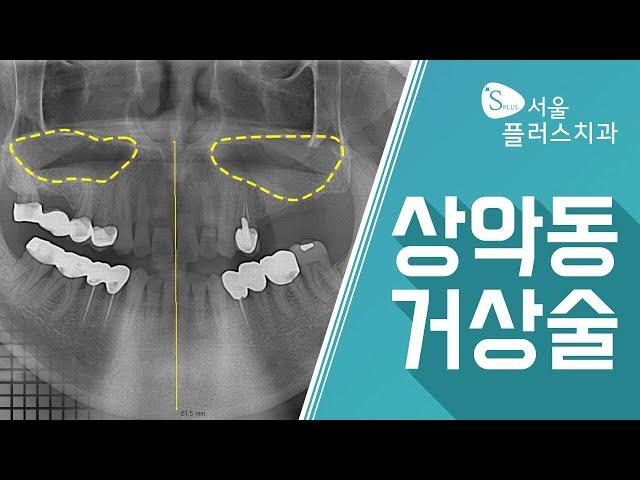 상악동거상술이라고 들어봤는데 잘 모르겠어요. [성남서울플러스 치과]