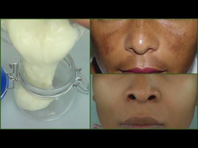 IN 7 DAYS REMOVE DARK SPOTS AND SCARS |PERMANENT DARK SPOTS + SCARS  REMOVER CREAM Khichi Beauty