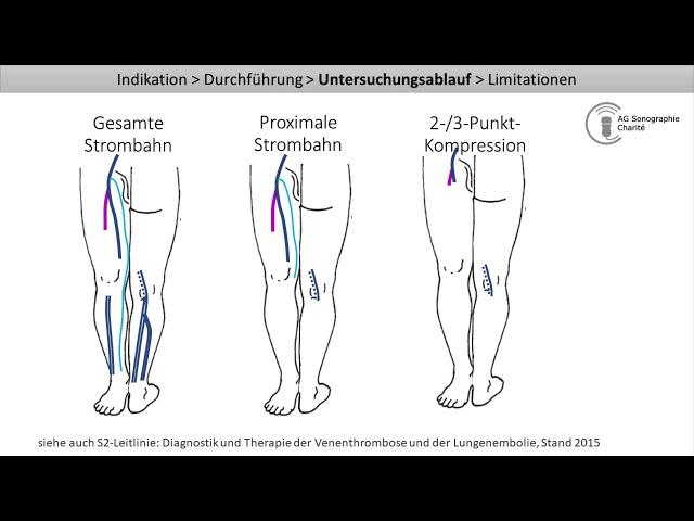 Kompressionssonographie der Beinvenen - Ausschluss einer tiefen Venenthrombose (TVT-Auschluss)
