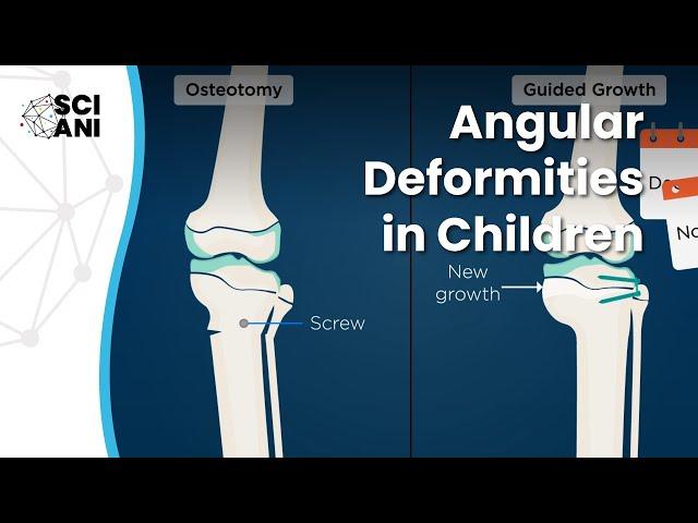 Bow legs and knock knees in children: when and how to correct them