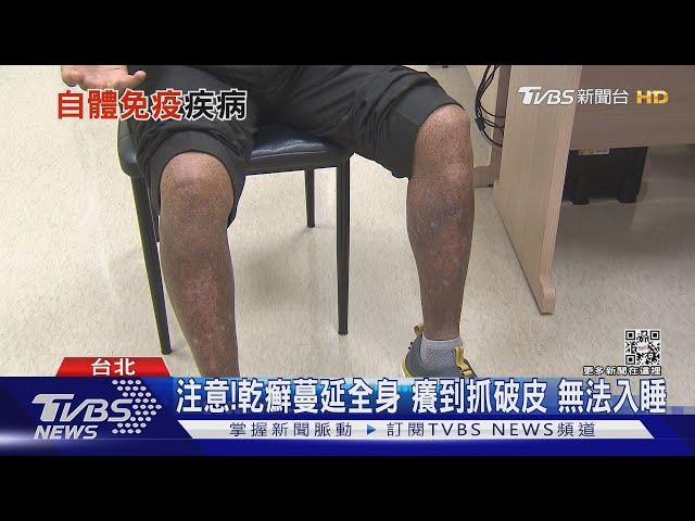 輕忽「自體免疫疾病」..症狀難以想像...醫警告別延誤就醫!｜十點不一樣20211210