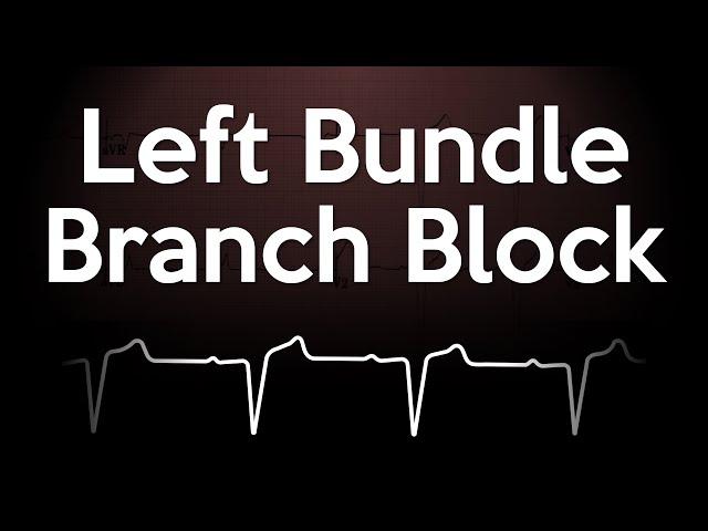 Left Bundle Branch Block ECG Explained