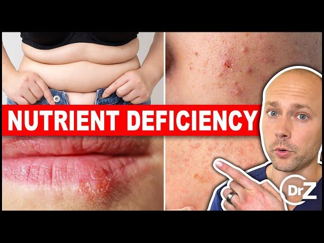 5 Common Nutrient Deficiencies In Modern People