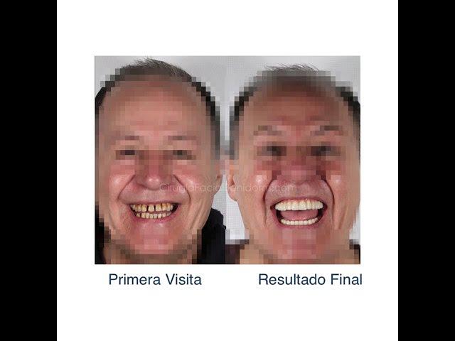 Eliminamos los focos de infección enfermedad periodontal generalizada con movilidad de piezas.