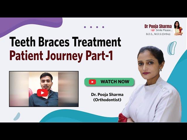 Teeth Braces Treatment Experience | Orthodontist in Agra for Smile Makeover - Dr Pooja Sharma Agra