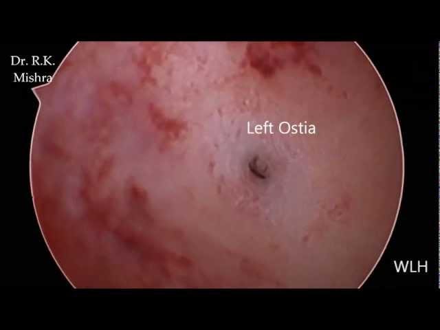 Diagnostic Hysteroscopy by Dr. R.K. Mishra
