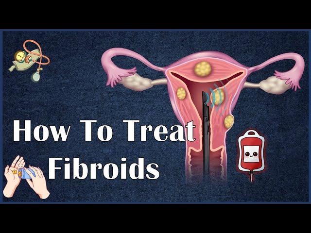 How To Treat Fibroids |Treatment Of Uterine Fibroids
