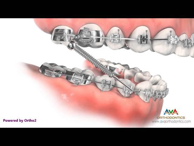 Orthodontic Treatment for Overjet (Overbite) - Forsus Appliance