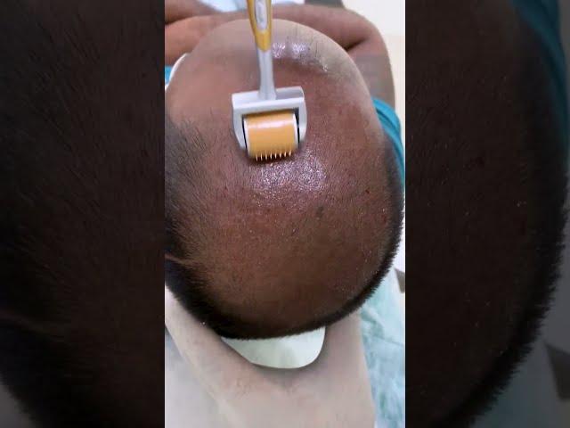 PRP - Best hair loss treatment | Hair loss treatment | derma roller hair regrowth | Skinaa Clinic