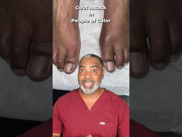 Gout Attack In People of Color