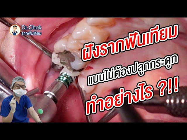 ฝังรากฟันเทียมโดยไม่ปลูกกระดูก พี่หมอทำอย่างไร ?! | คลายปัญหารากฟันเทียมกับหมอโชค