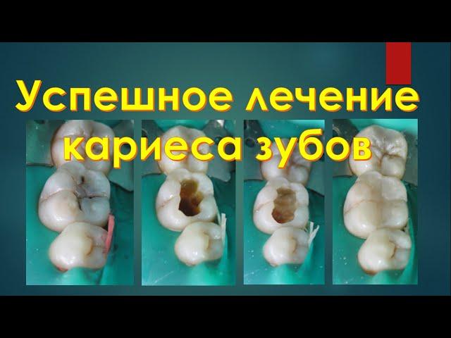 Секреты Стоматологии - Глава 2. Лечение Кариеса