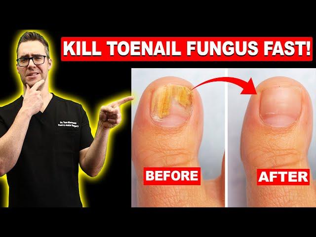 #1 BEST Toenail Fungus Treatment? [Top 10 Home Remedies] 2024