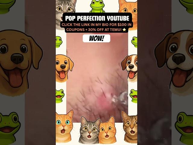 Wow! #youtubeshorts #youtube #shortsfeed #shortvideo #shorts #short #pimple #pimplepopping #pimples