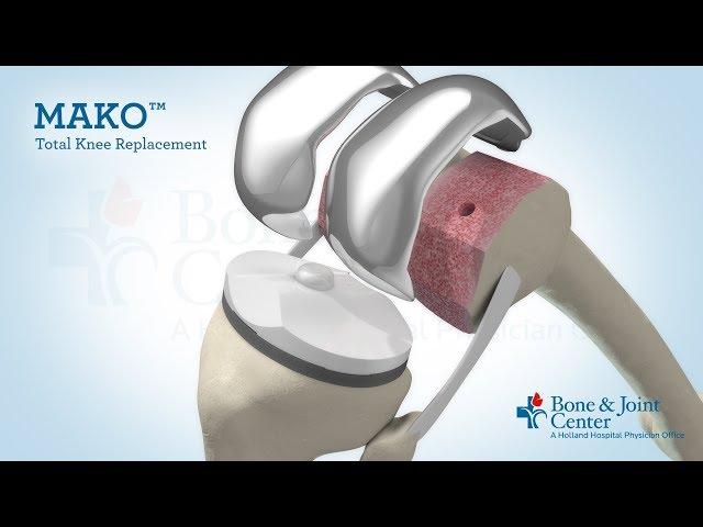 Full Knee Replacement | Mako Robotic Arm Assisted Surgery Technology