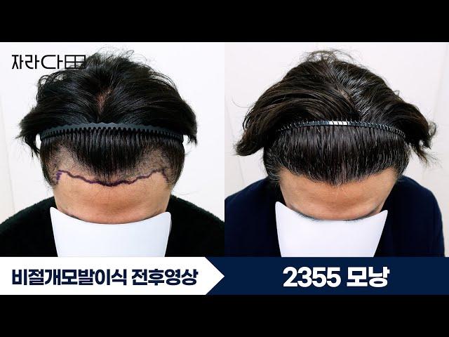 2355모낭 비절개모발이식 M자 헤어라인 #자라다의원