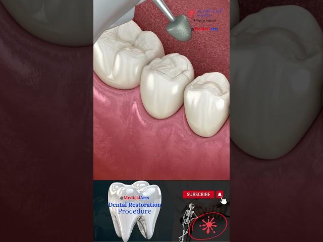 Dental Restoration ↪ Composite Bonding Teeth  ↪ 3D Medical Animation