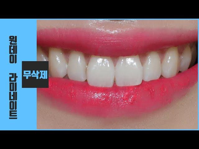 무삭제 원데이 라미네이트,  Oneday Laminate veneer without tooth preparation, một ngày laminate