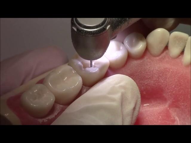 Tutorial on Class I Cavity Preparation Amalgam Restoration - DENTALKART