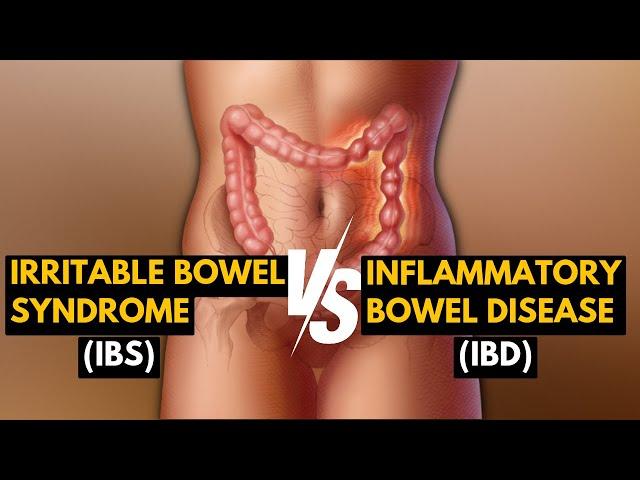 Difference between IBS (Irritable bowel Syndrome) and IBD (Inflammatory bowel disease)